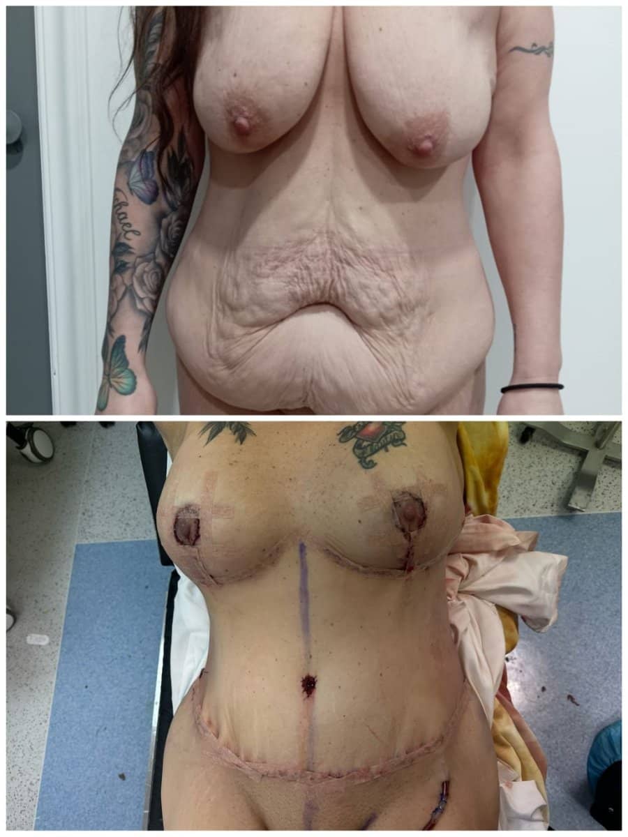 Case 17295 - tummy tuck
