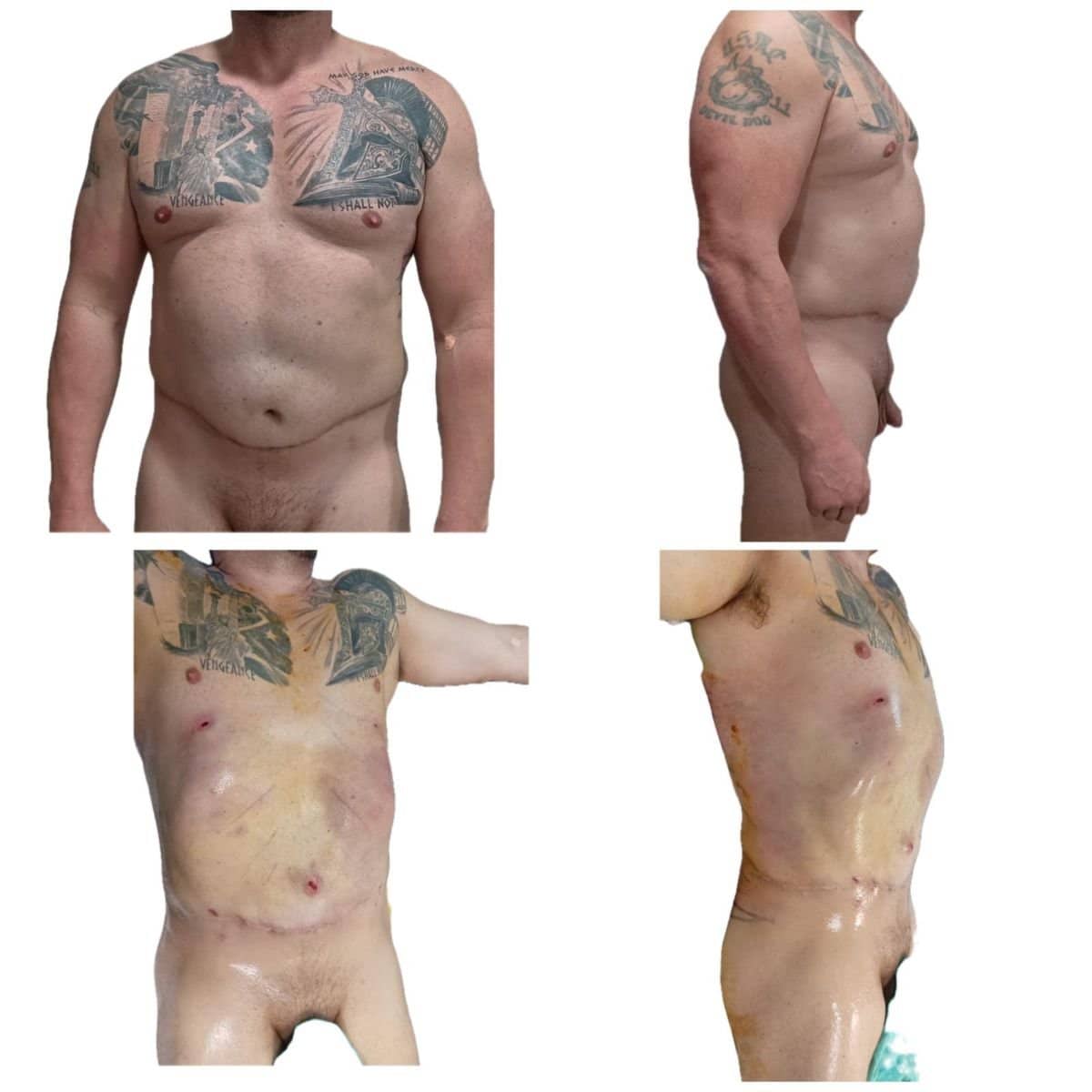 Case 17297 - liposuction