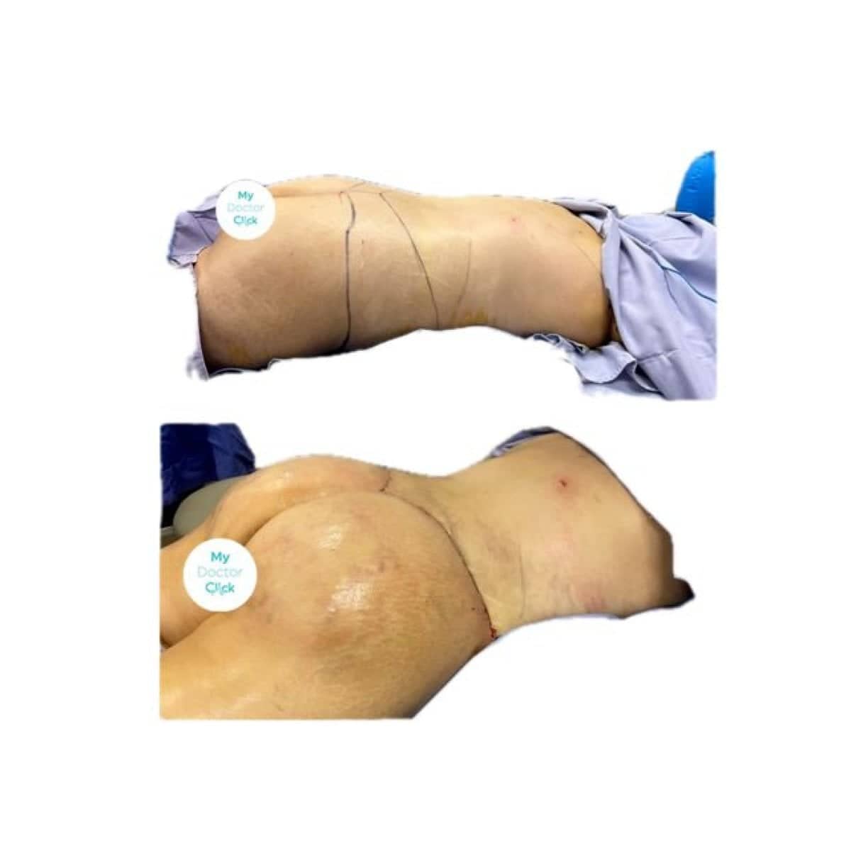 Case 17299 - post-bariatric plastic surgery