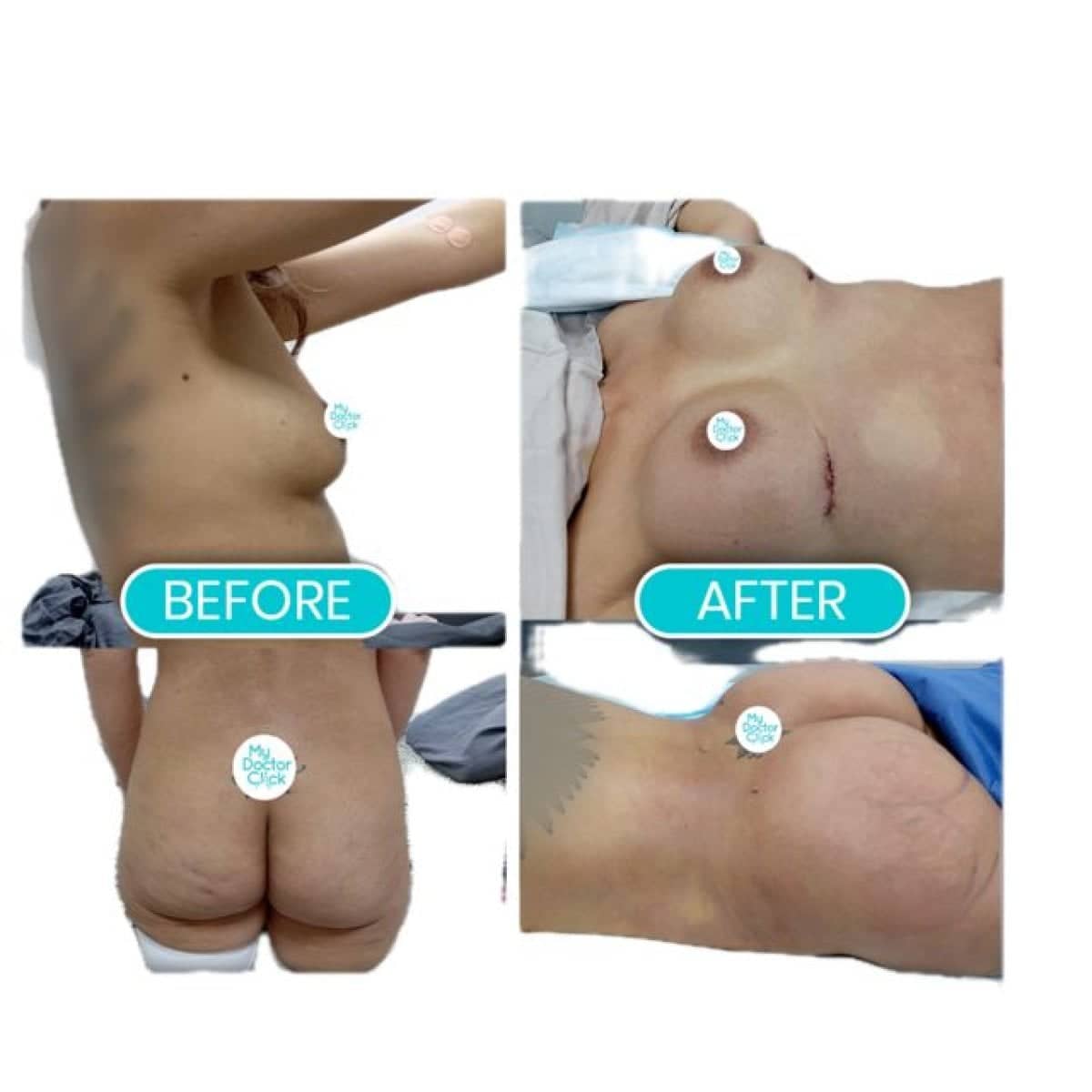 Case 17300 - post-bariatric plastic surgery