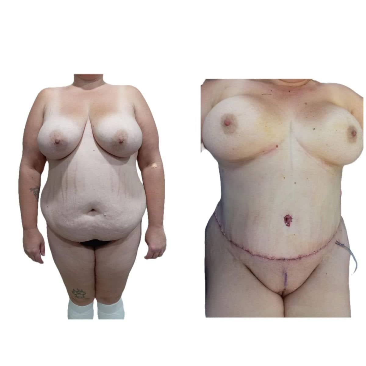Case 17301 - tummy tuck