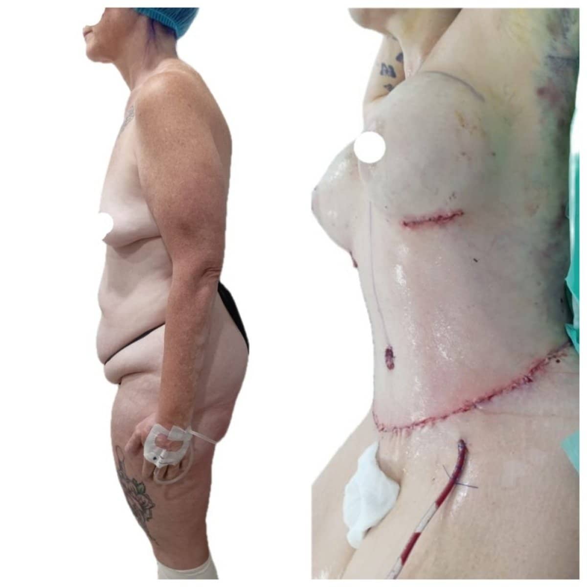 Case 17305 - tummy tuck