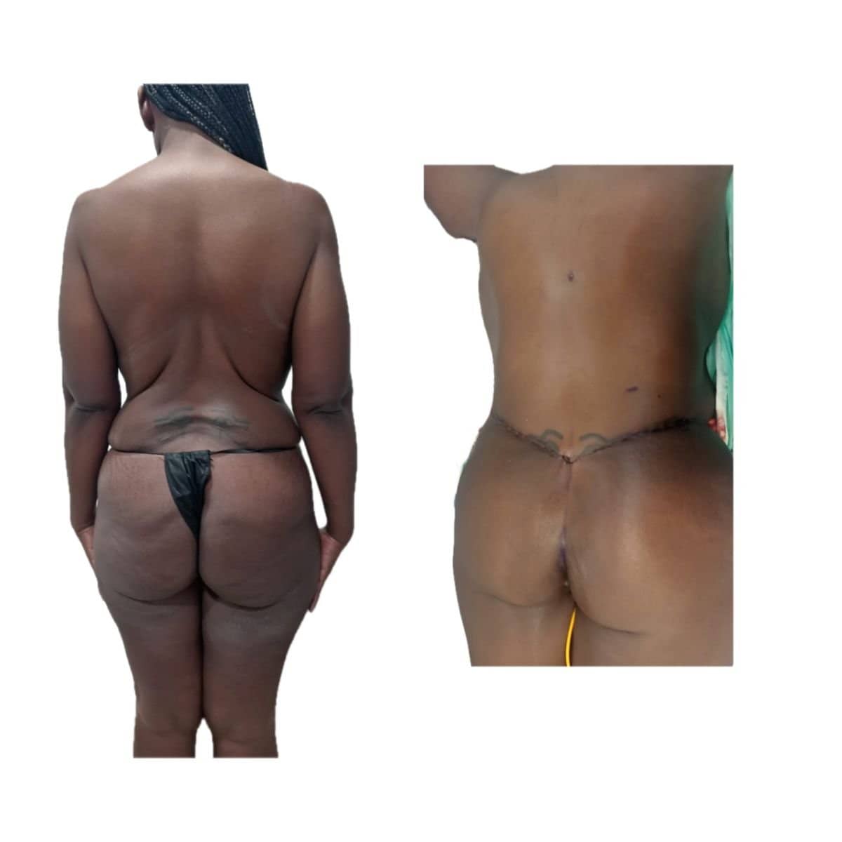 Case 17307 - post-bariatric plastic surgery