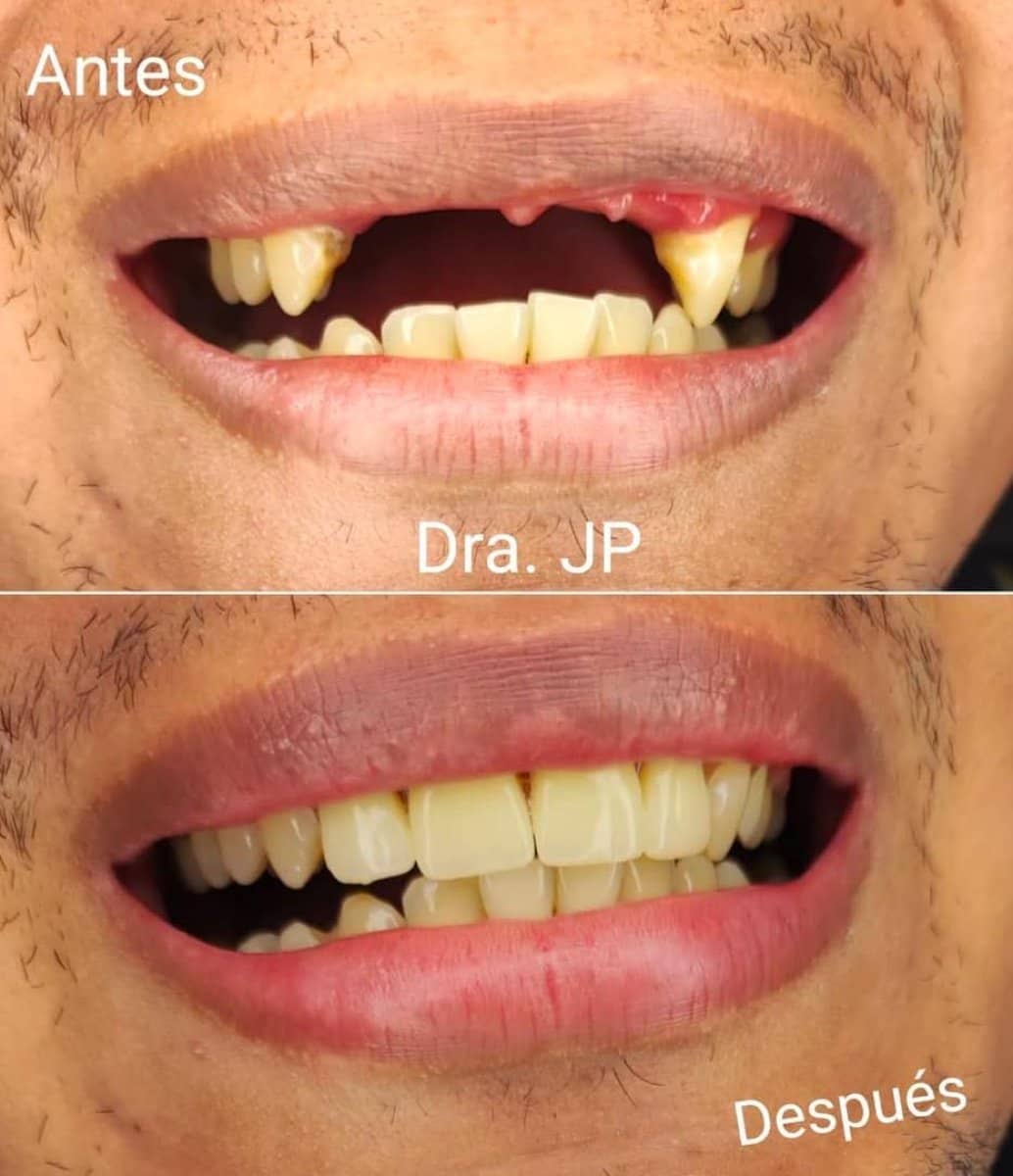 Case 17312 - aesthetic temporary prosthesis