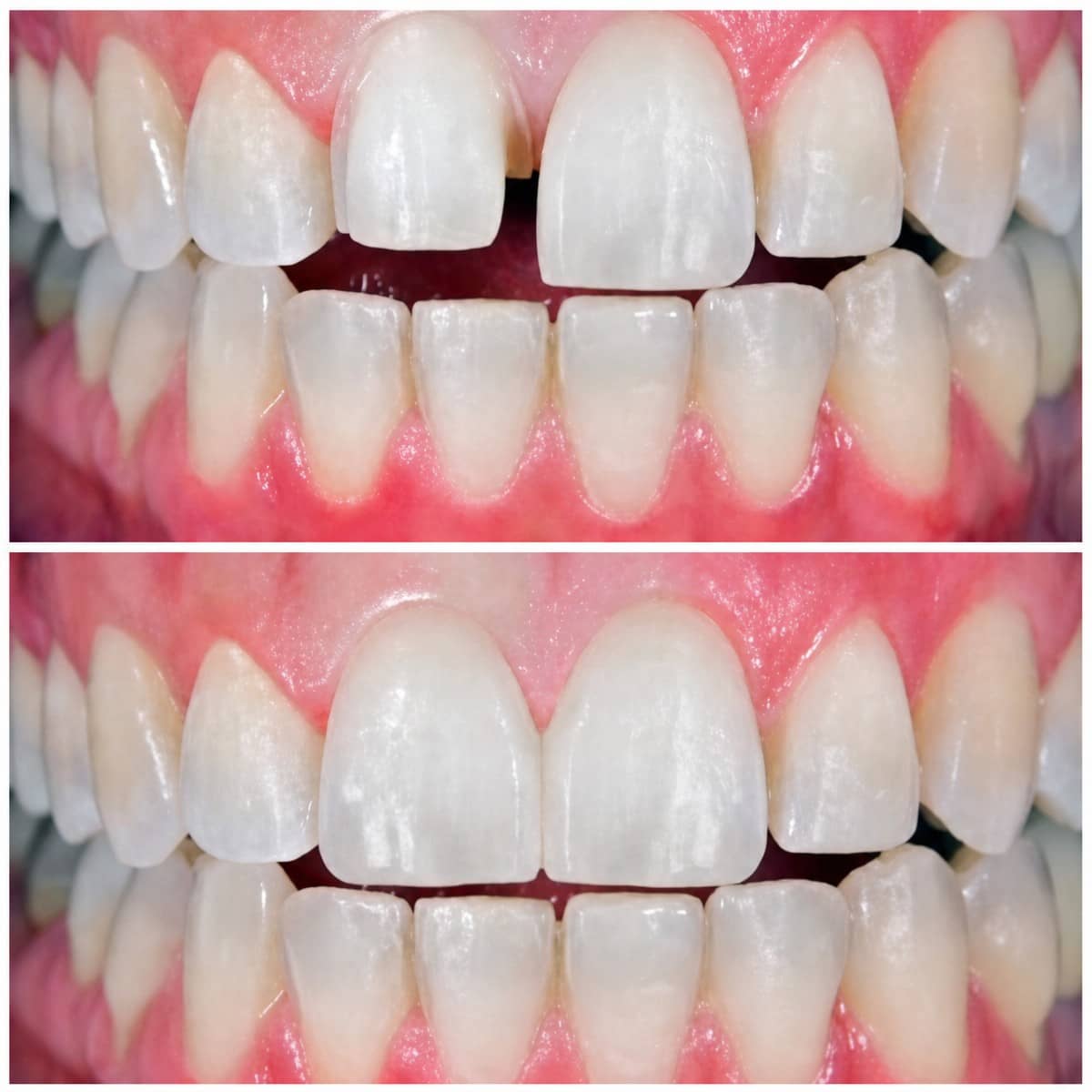 Case 17313 - veneers