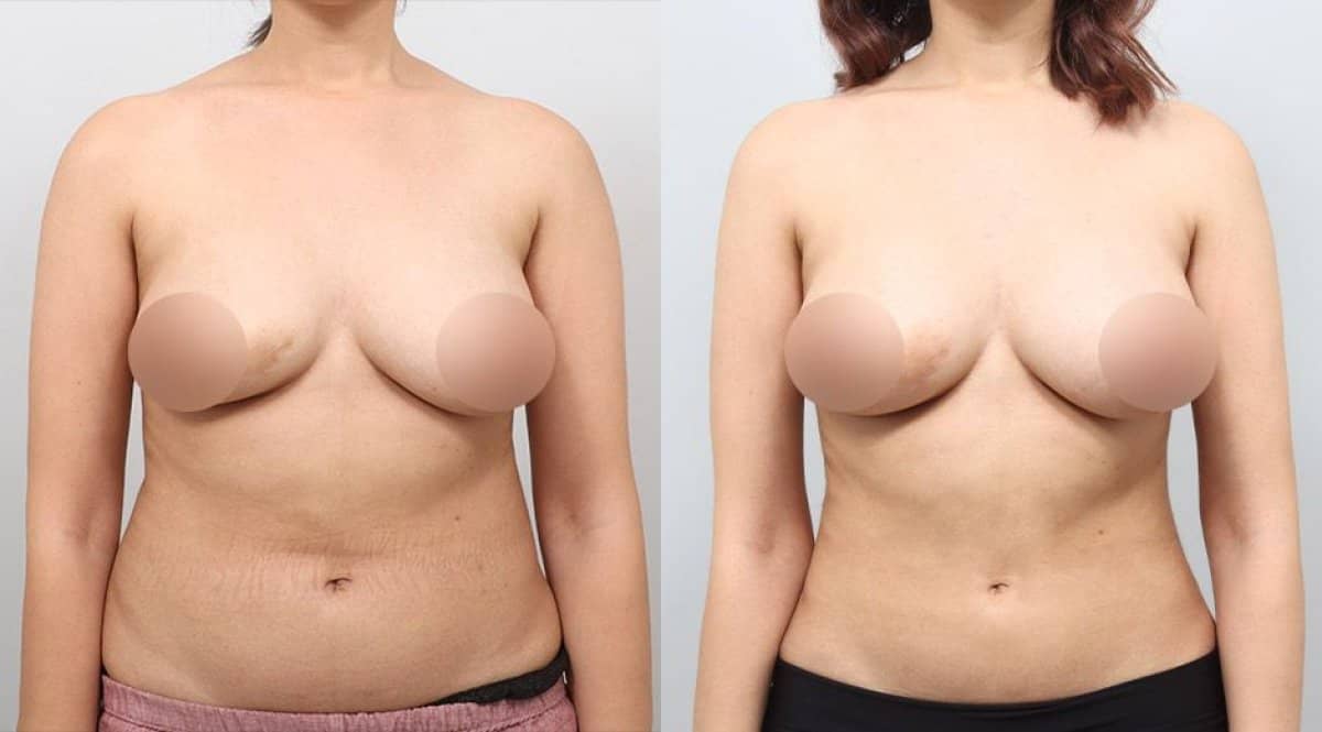 Case 17327 - BodyTite body contouring
