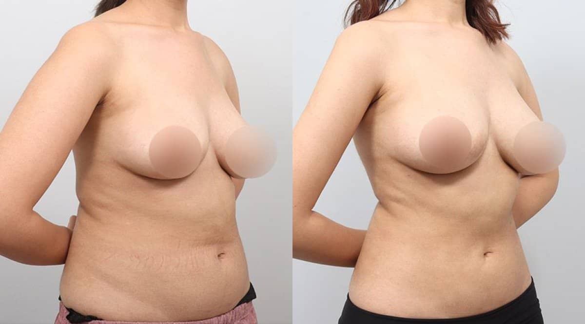 Case 17329 - BodyTite body contouring