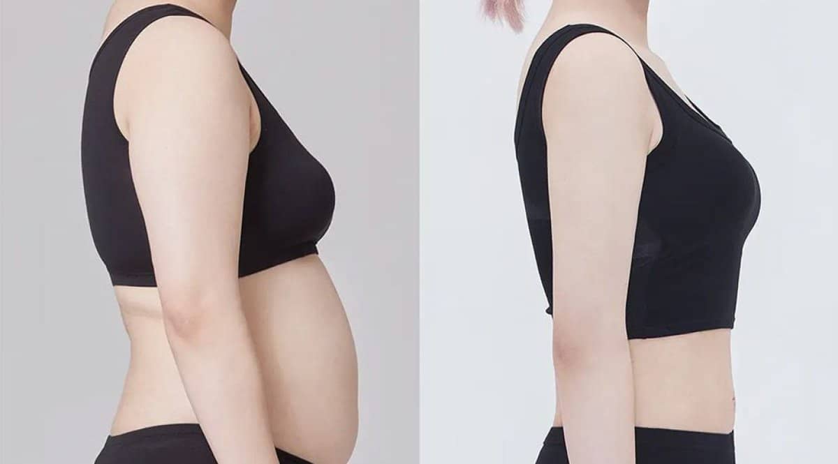 Case 17331 - BodyTite body contouring