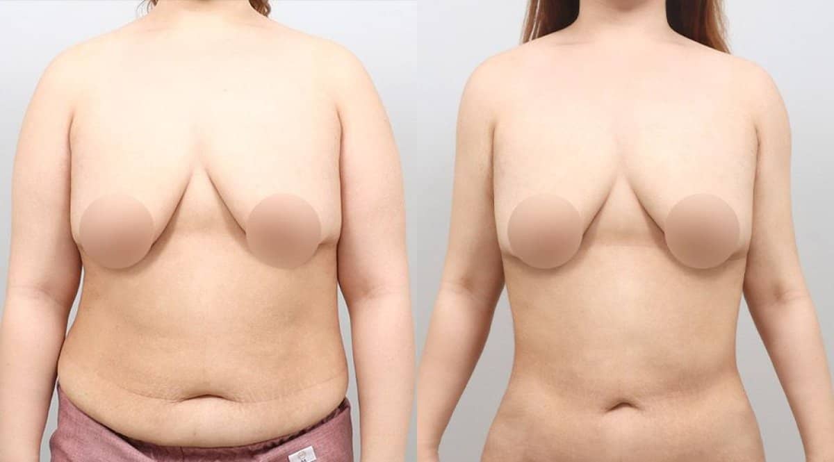 Case 17332 - BodyTite body contouring