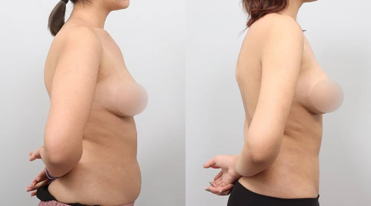 Case 17334 - BodyTite body contouring