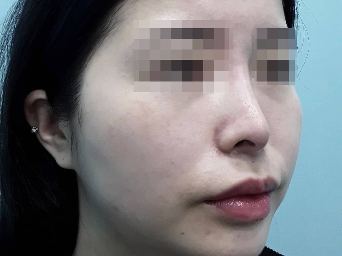 Case 17356 - before and after