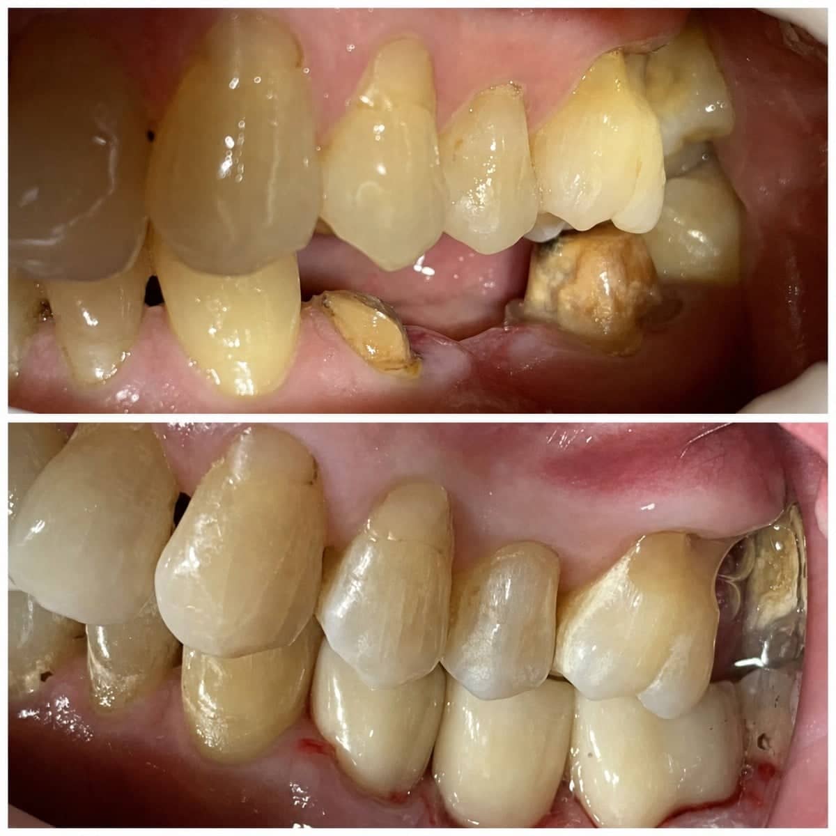 Case 17417 - mini dental implant