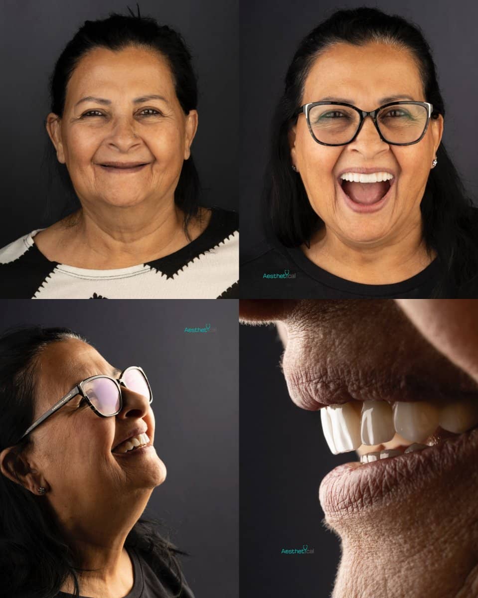 Case 17419 - All-on-6 dental implants