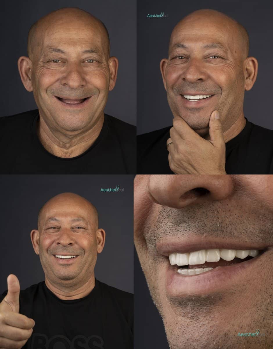 Case 17420 - All-on-6 dental implants