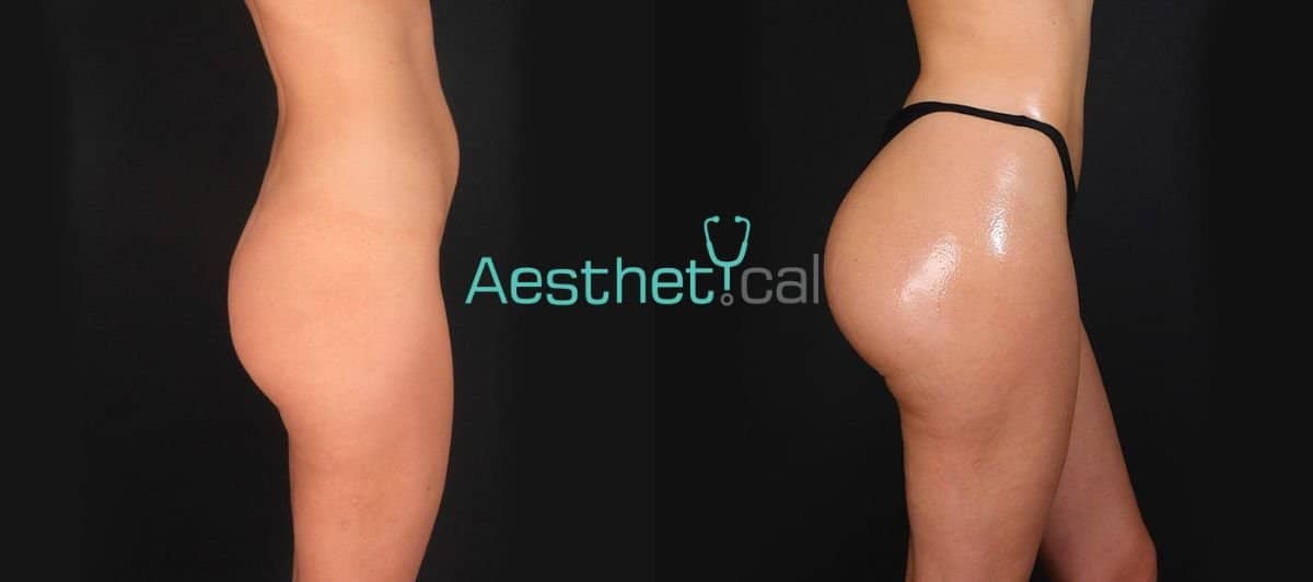 Case 17421 - Brazilian Butt Lift