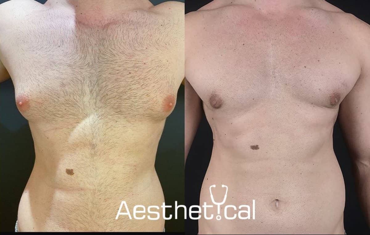 Case 17423 - gynecomastia Vaser liposuction