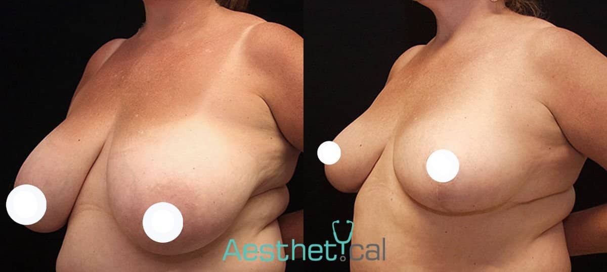 Case 17425 - breast reduction