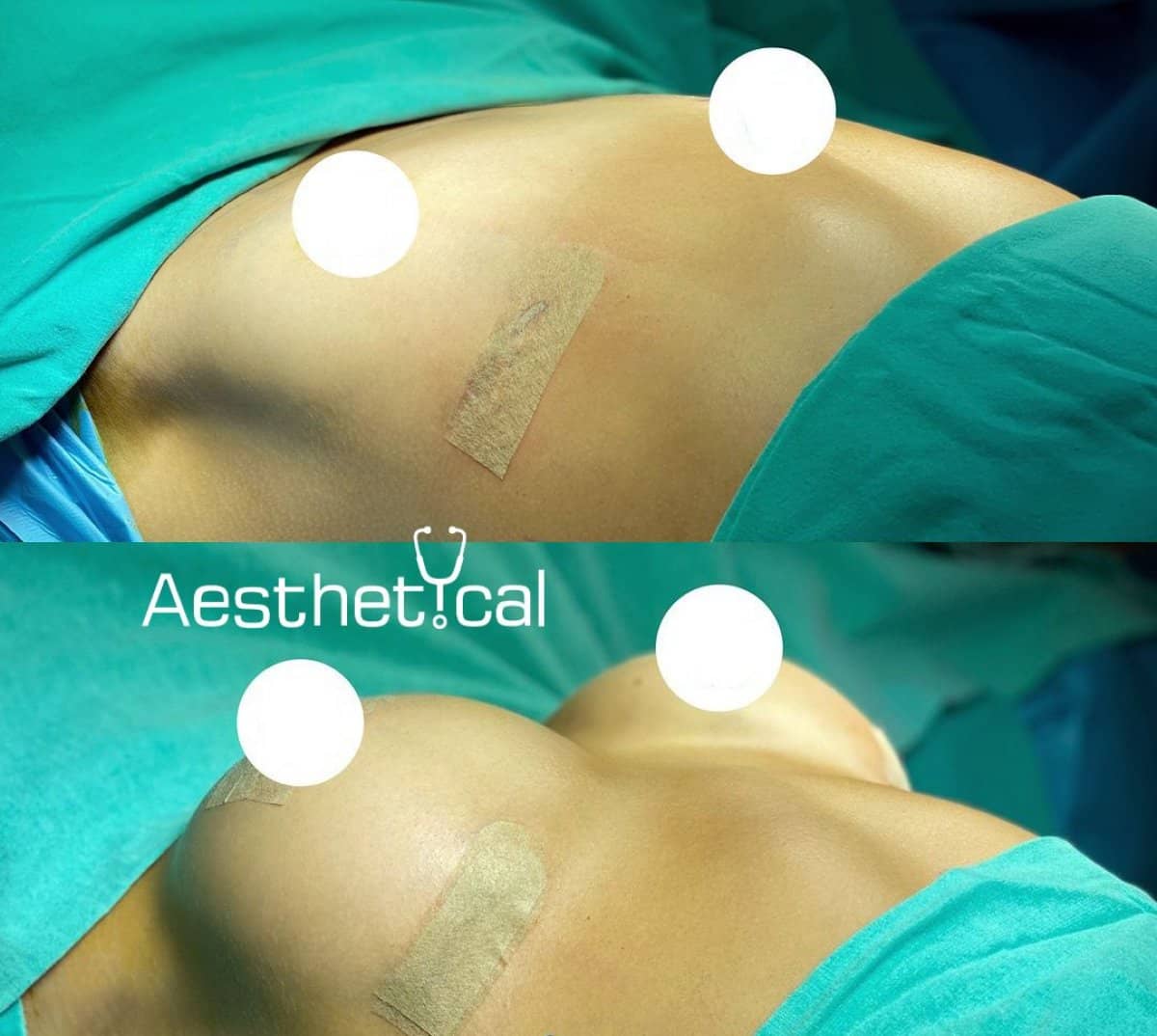 Case 17426 - breast augmentation