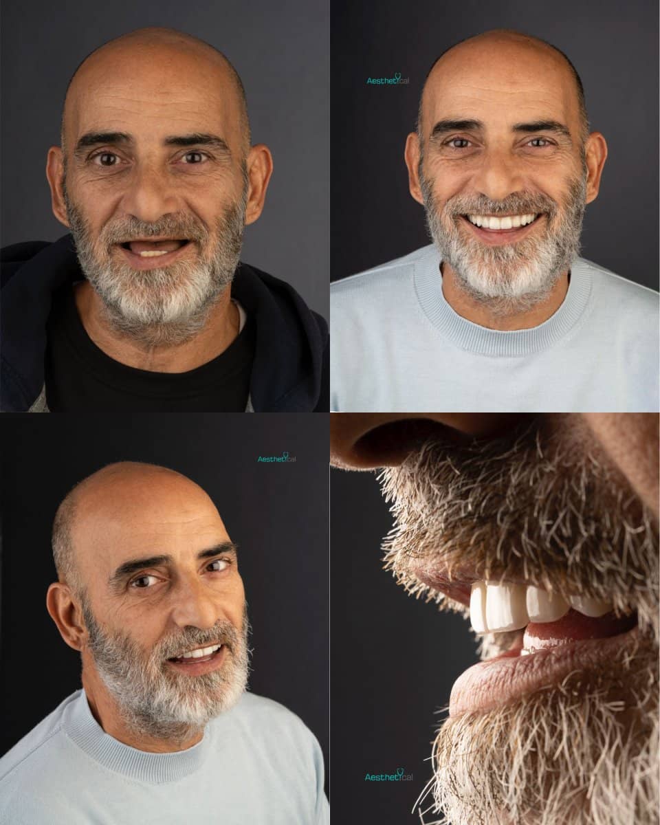 Case 17427 - All-on-6 dental implants