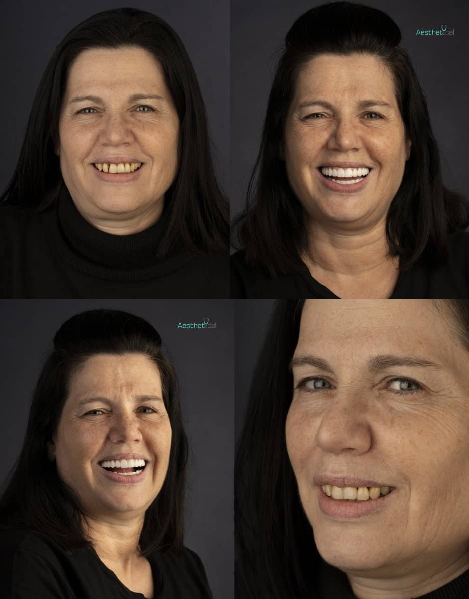 Case 17428 - dental implant