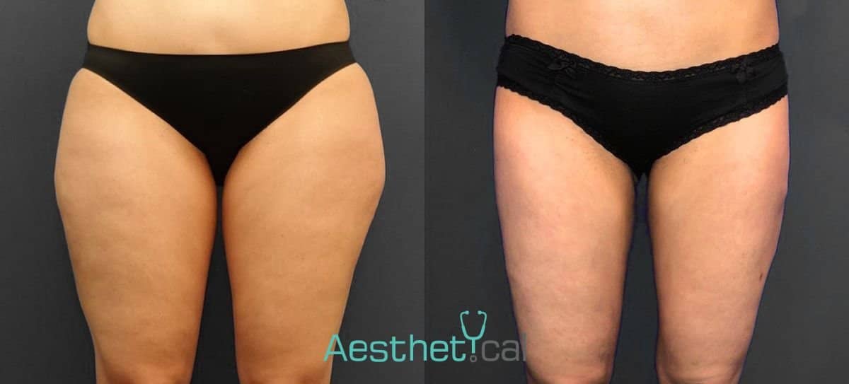 Case 17429 - thigh liposuction