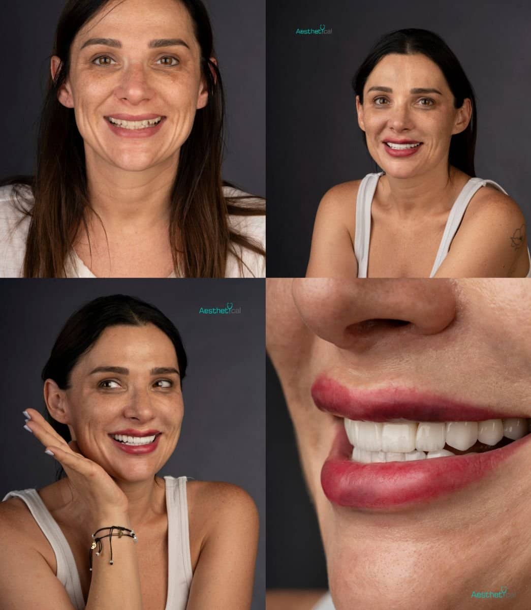 Case 17430 - veneers