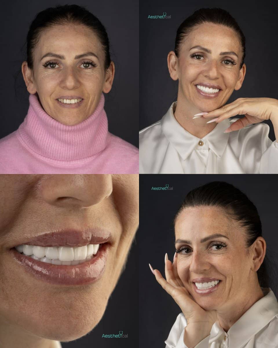 Case 17431 - All-on-6 dental implants