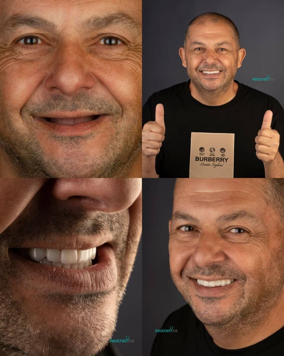 Case 17432 - Zygomatic All-on-2 implants
