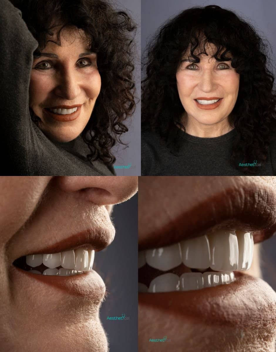 Case 17433 - before and after