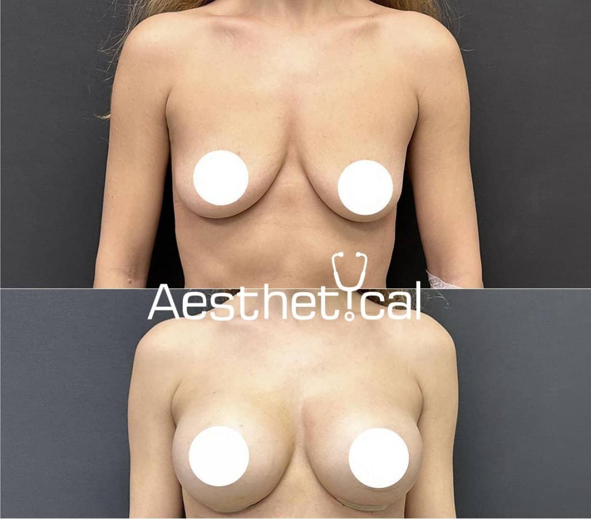 Case 17434 - breast augmentation
