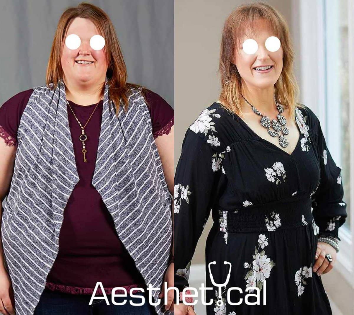 Case 17435 - gastric sleeve surgery