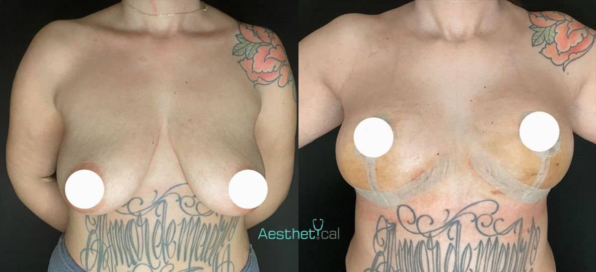 Case 17437 - breast lift