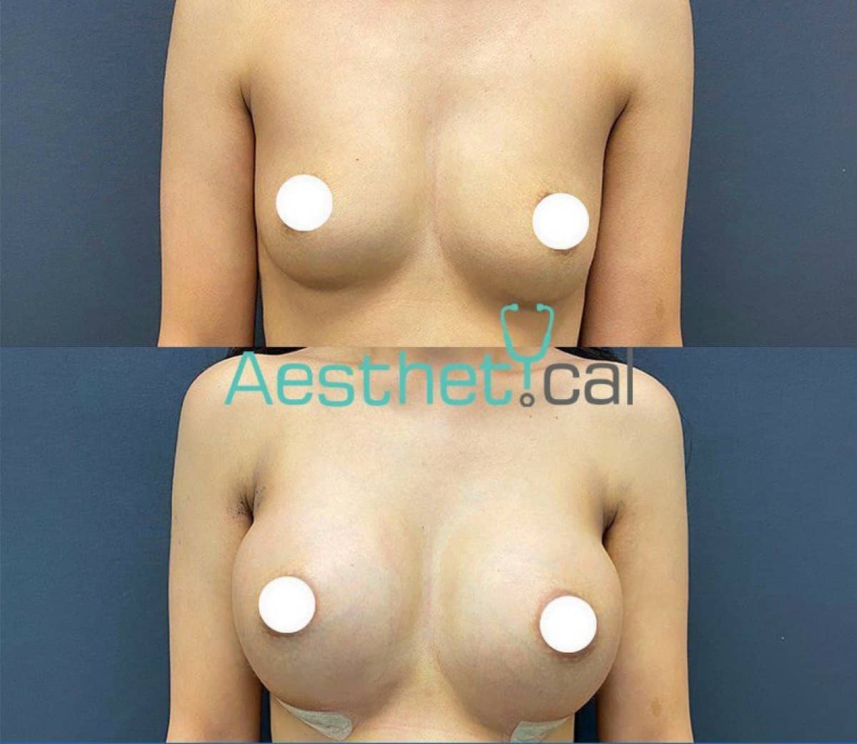 Case 17438 - breast augmentation