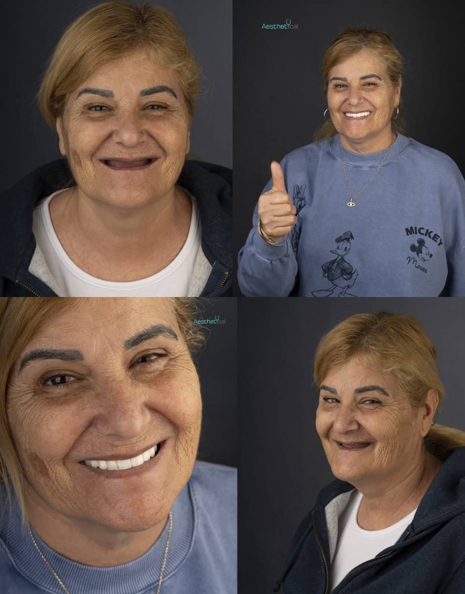 Case 17440 - All-on-4 dental implants