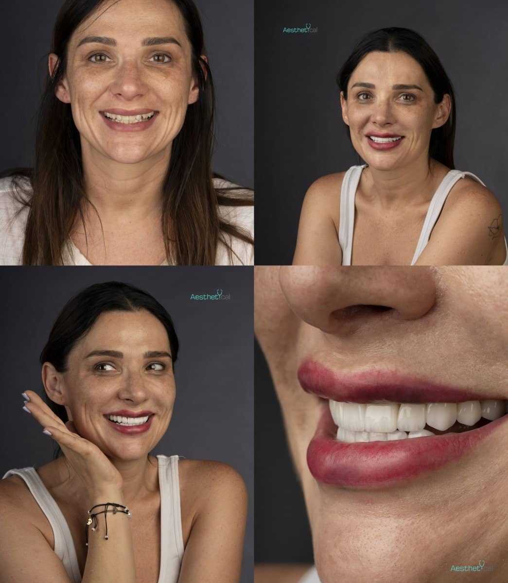 Case 17441 - veneers