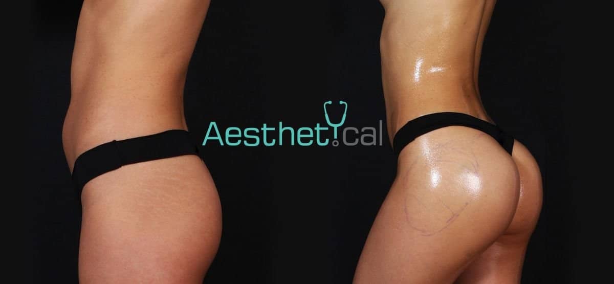 Case 17444 - Brazilian Butt Lift