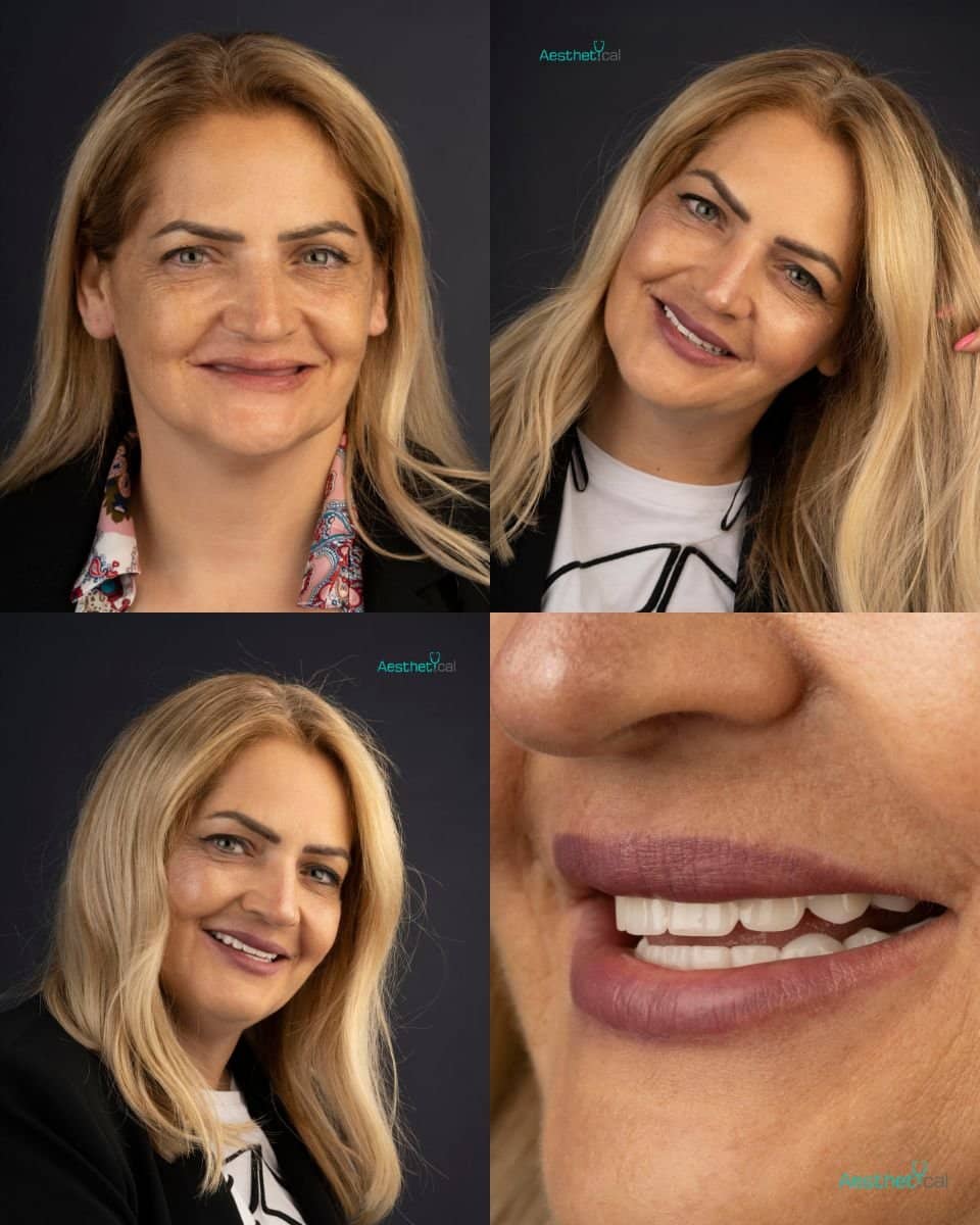 Case 17445 - Zygomatic All-on-2 implants