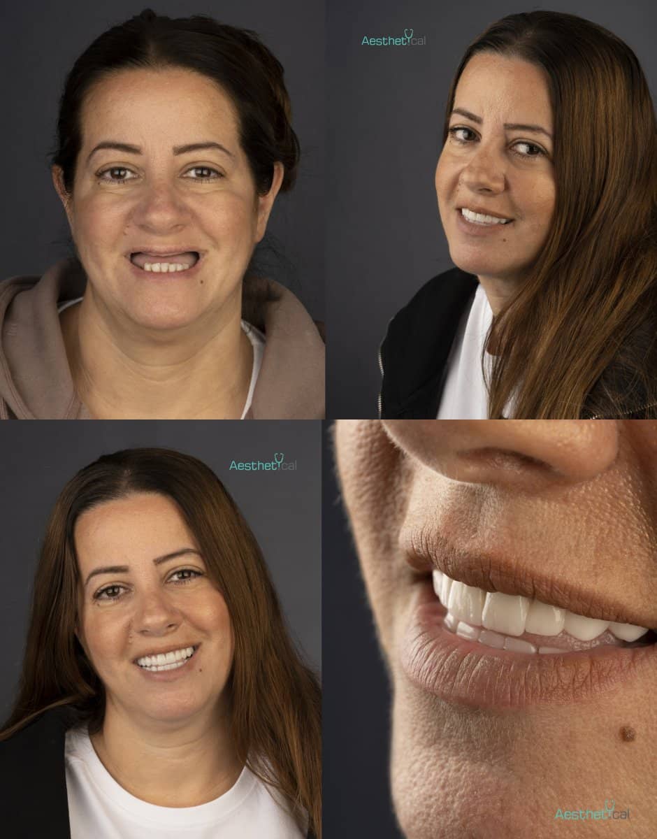 Case 17448 - dental implant