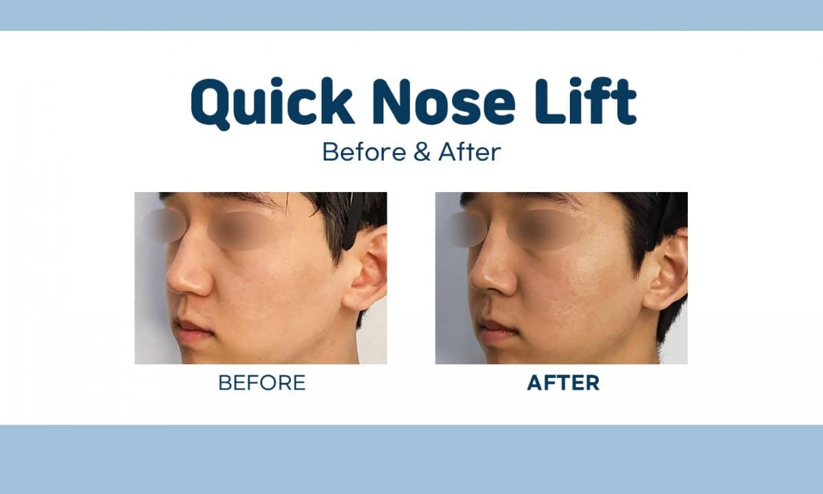 Case 17451 - quick nose lift