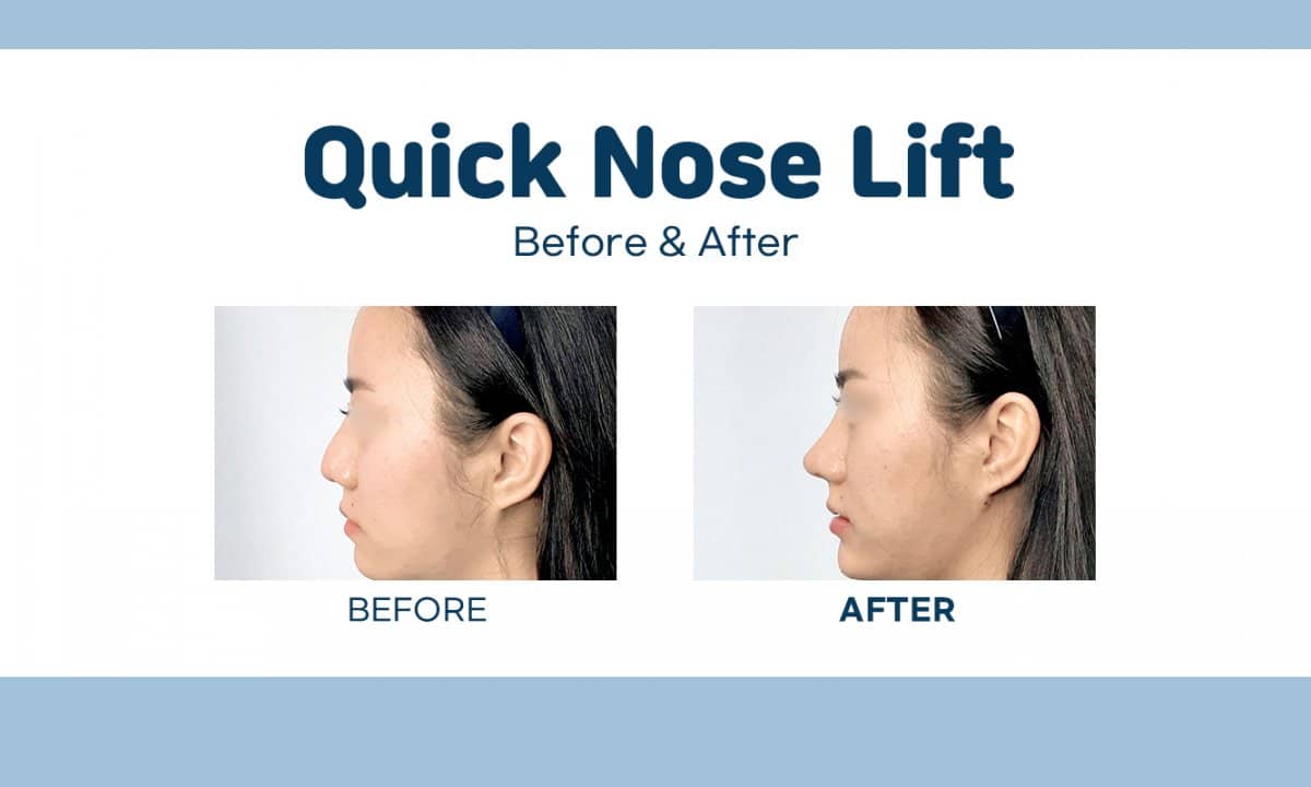 Case 17453 - quick nose lift