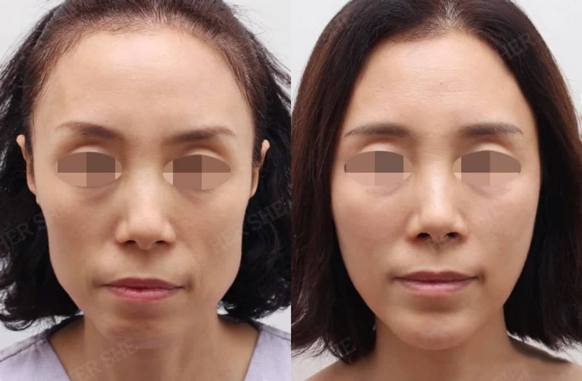 Case 17455 - facial lipofilling
