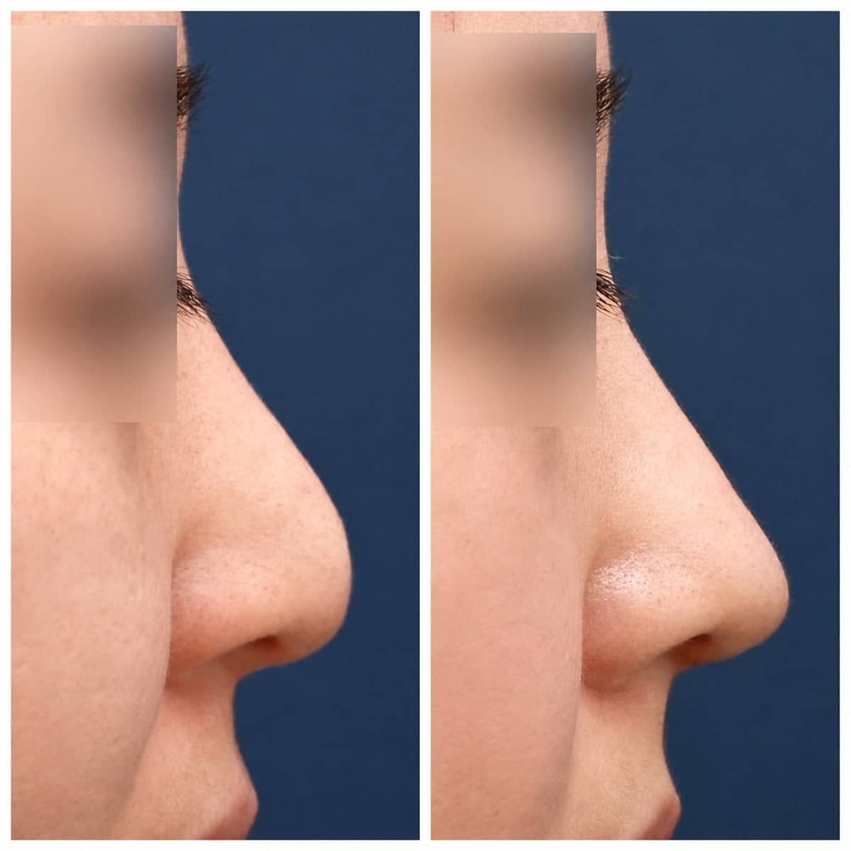 Case 17456 - rhinoplasty