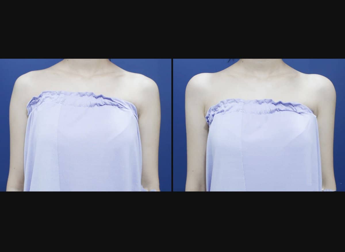 Case 17458 - hyaluronic acid fillers for shoulder contouring