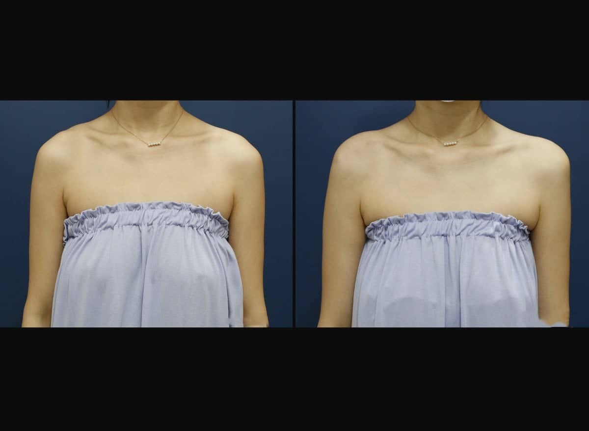 Case 17460 - hyaluronic acid fillers for shoulder contouring