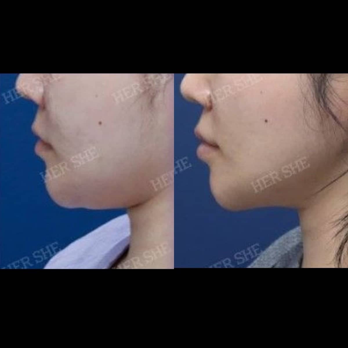 Case 17461 - facial fat transfer