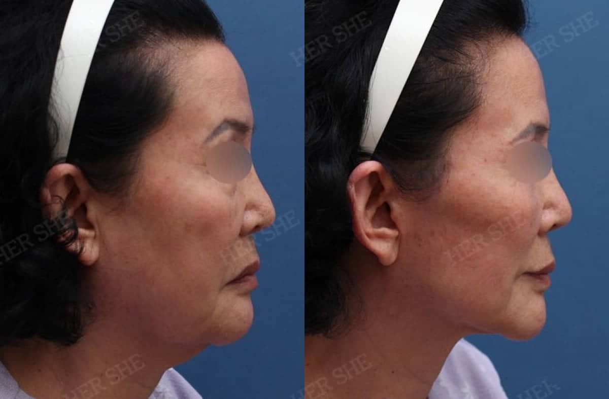 Case 17465 - deep plane facelift