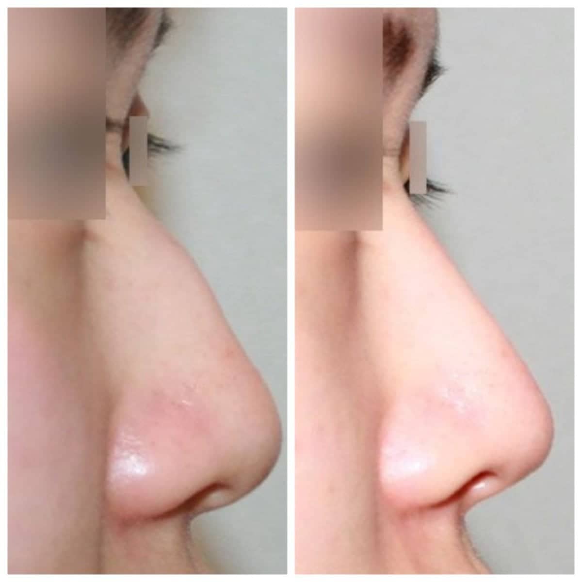 Case 17466 - rhinoplasty
