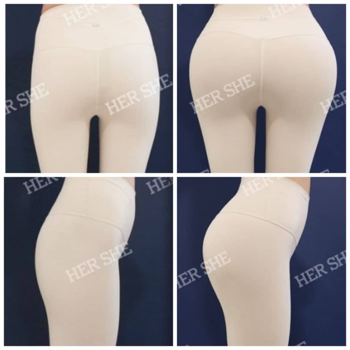 Case 17467 - Brazilian Butt Lift