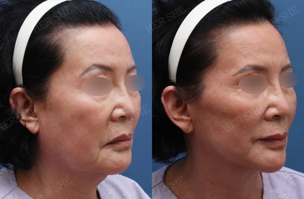 Case 17471 - deep plane facelift