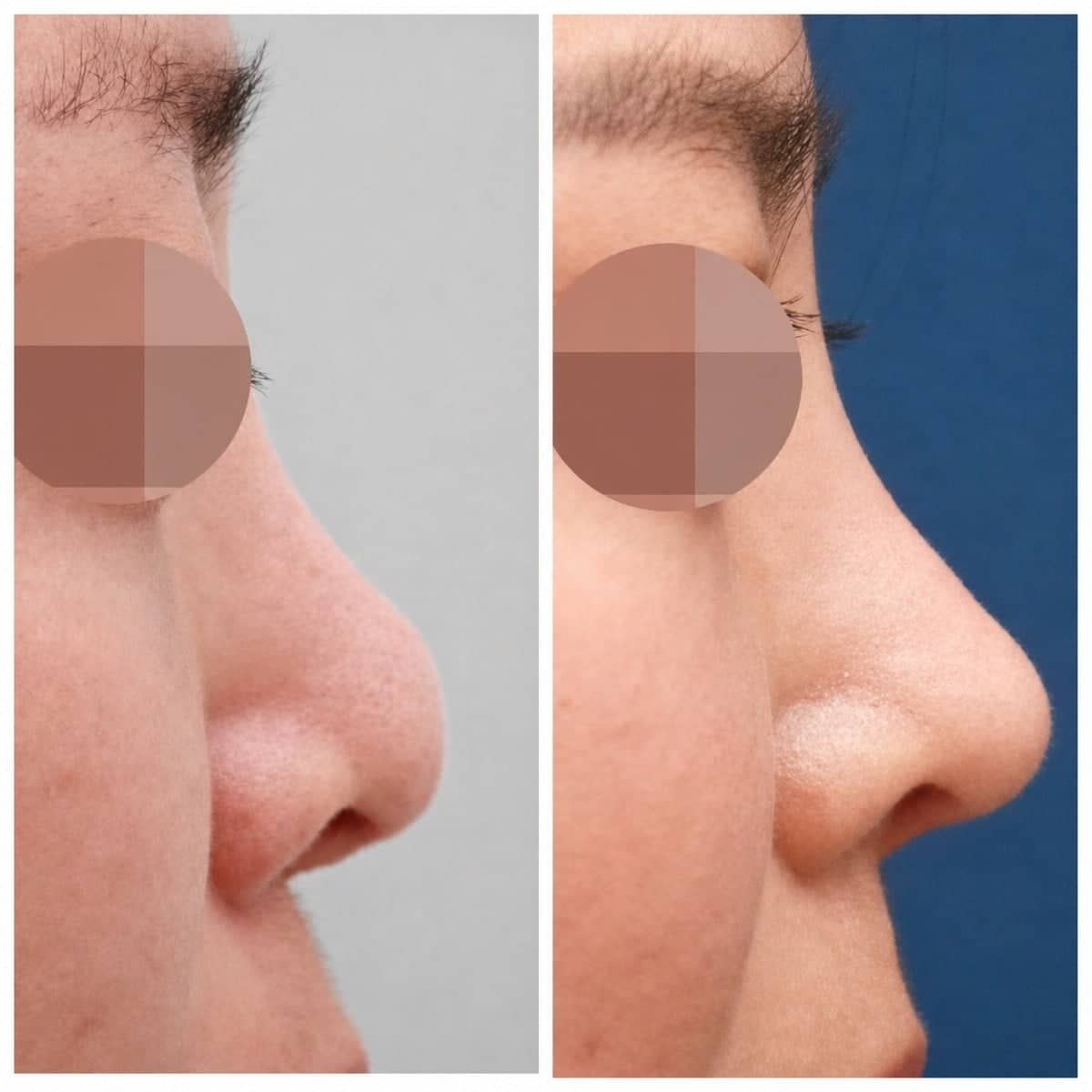 Case 17473 - rhinoplasty